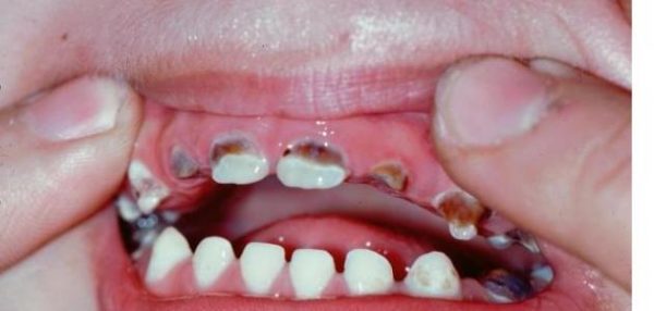 الطب النبوى وعلاج تسوس الأسنان