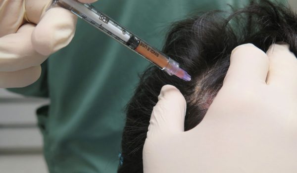 عملية حقن الشعر بالبلازما