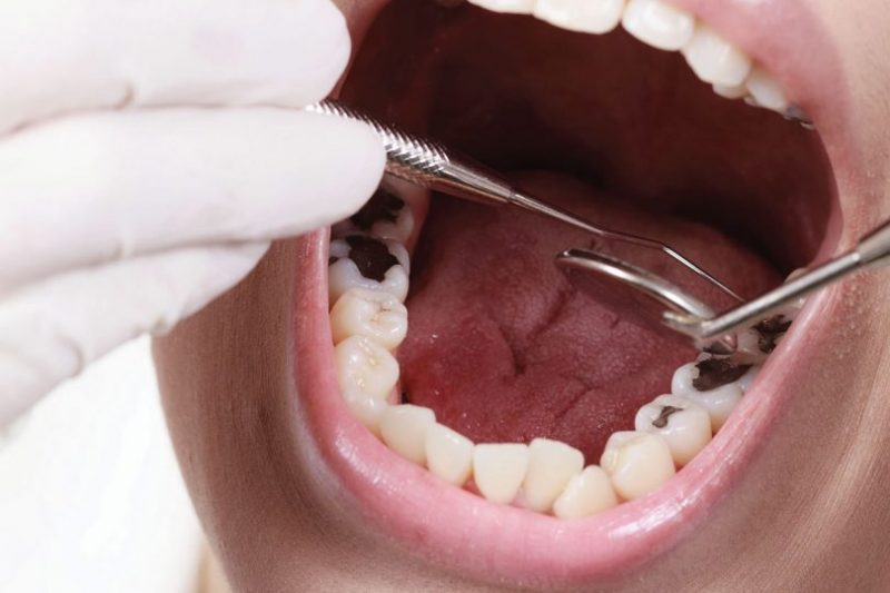 علاج تسوس الأسنان بالطب البديل