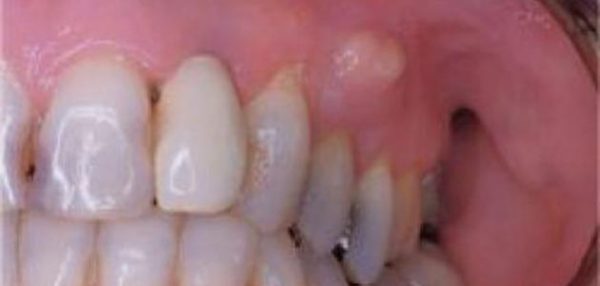 علاج خراج الأسنان بطرق طبيعية من المنزل