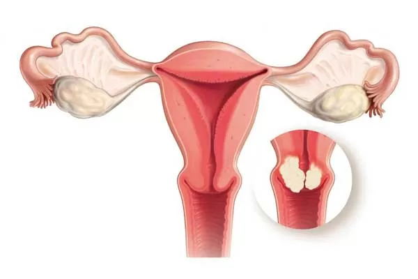 تجارب النساء بعد استئصال الرحم
