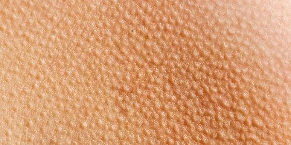 تجربتي في علاج جلد الوزة بالليزر