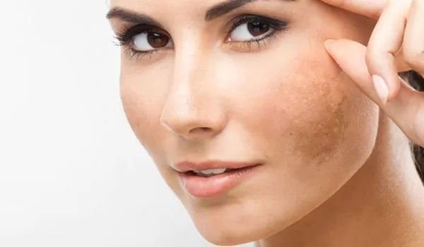 أهم الأسباب التي تؤدي لظهور البقع البنية في الوجه