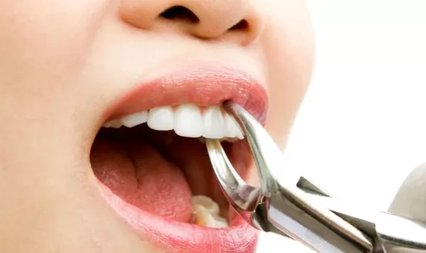 تفسير حلم سقوط الأسنان الأمامية العلوية في منام المتزوجة