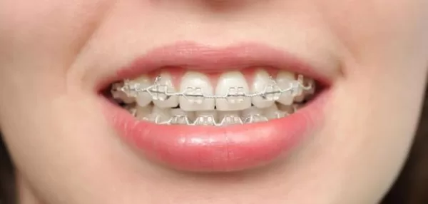 تفسير حلم تركيب تقويم الاسنان بالنسبة للفتاة العزباء