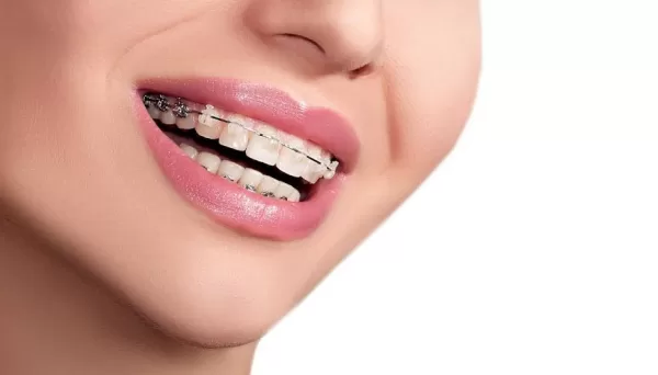 تفسير حلم تركيب تقويم الاسنان بالنسبة للمرأة المتزوجة
